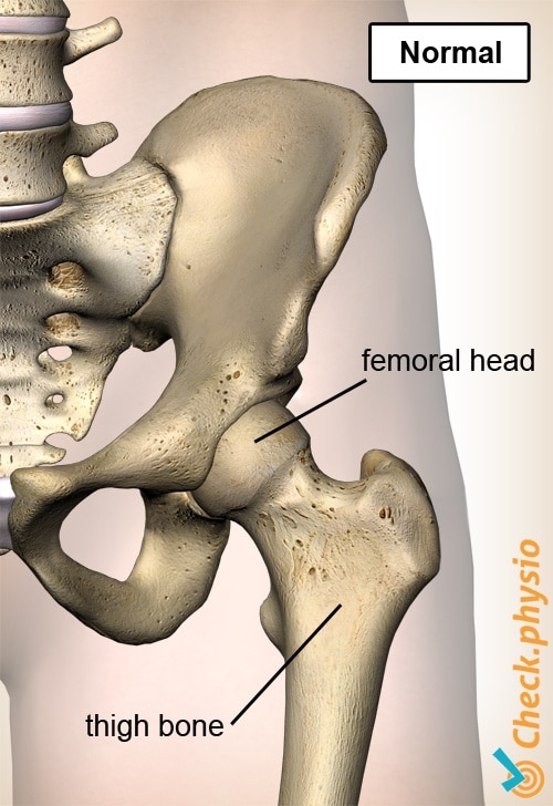 hip normal epiphysiolysis capitis femoris