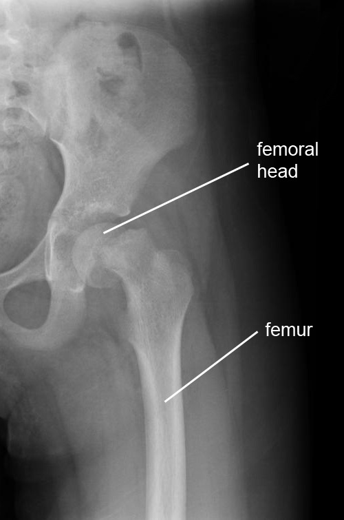 hip epiphysiolysis capitis femoris x-ray