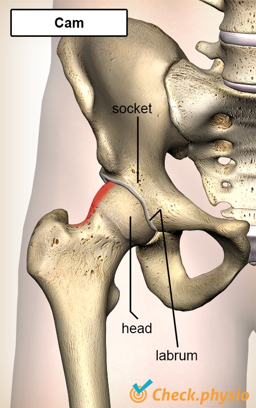 hip femoroacetabular impingement FAI cam head