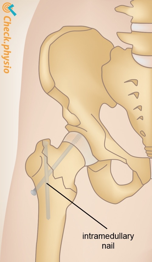 Subtrochanteric Fractures: Intramedullary Fixation | Musculoskeletal Key