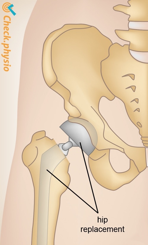 hip fracture prosthesis