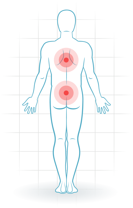 pijnlocatie Bechterew's disease