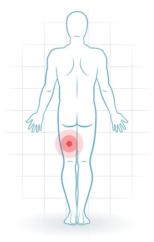 pijnlocatie Acute hamstring injury