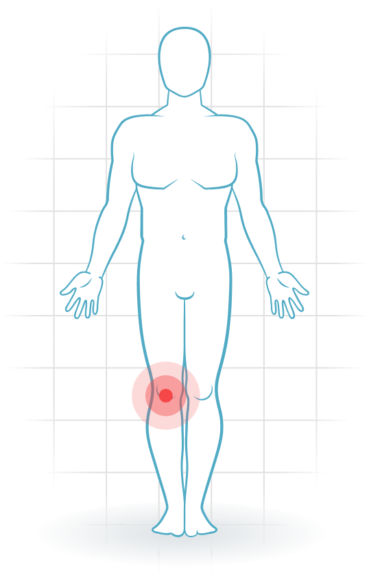 pijnlocatie Osteoarthritis of the knee