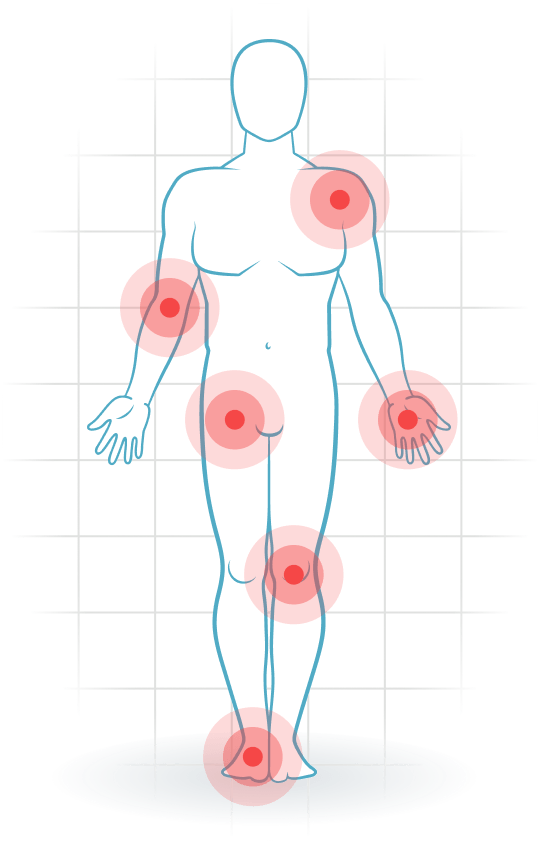 pijnlocatie Rheumatoid arthritis