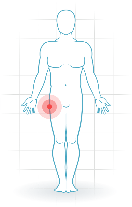 pijnlocatie Greater trochanteric pain syndrome