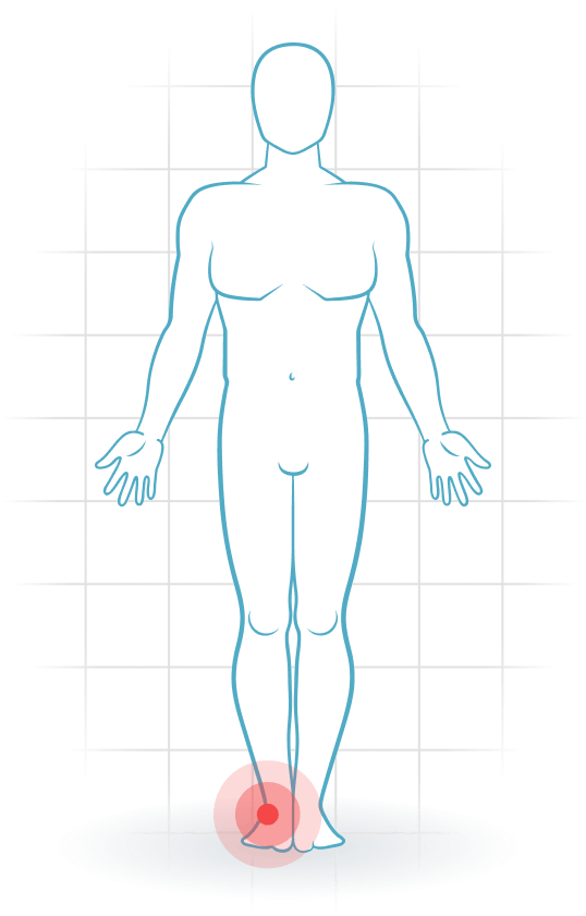 pijnlocatie Lateral ankle ligament injury