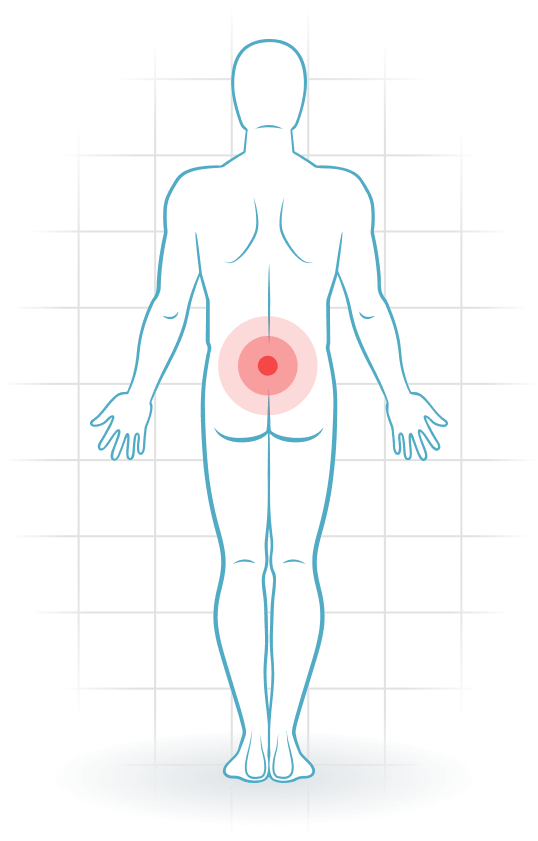 pijnlocatie Lumbar instability