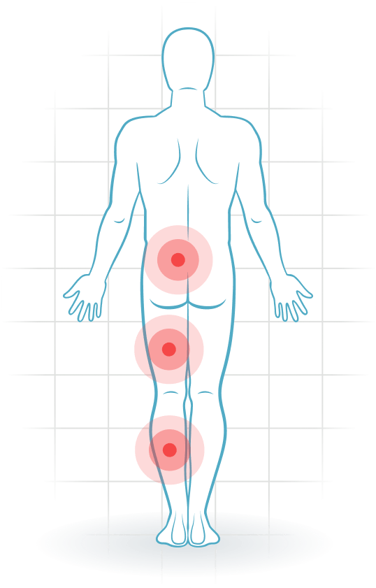 pijnlocatie Lumbosacral radicular syndrome