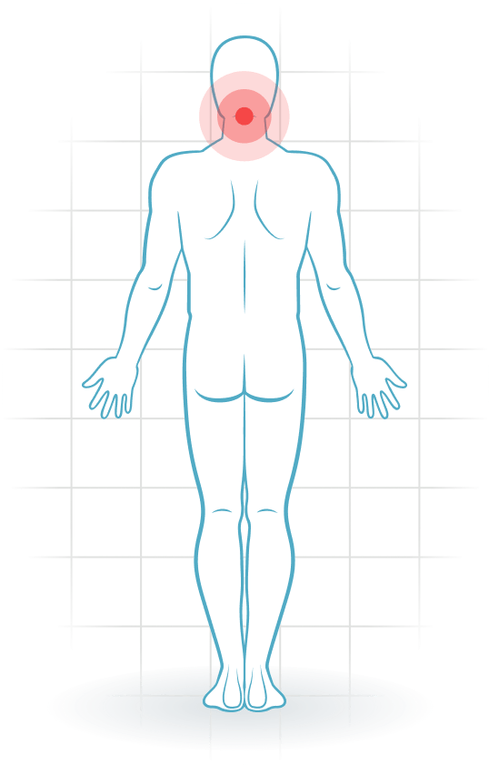 pijnlocatie Cervical facet syndrome