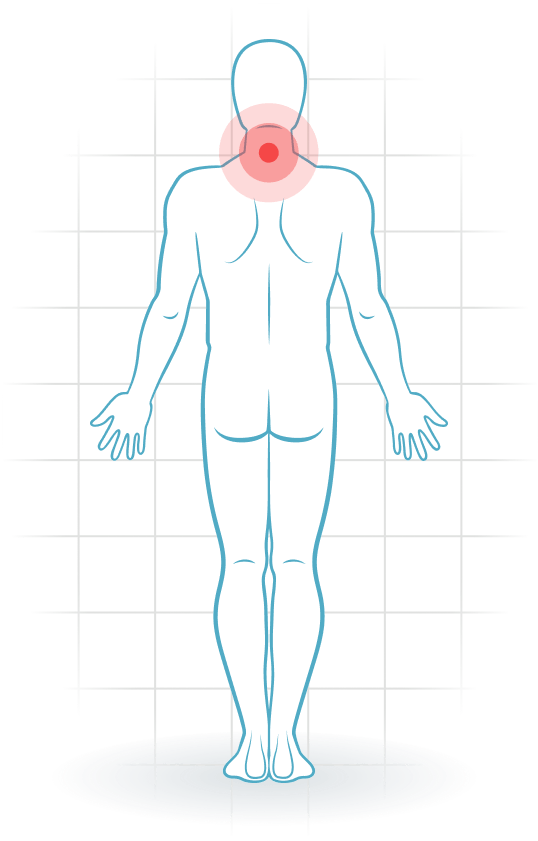 pijnlocatie Cervical posture syndrome