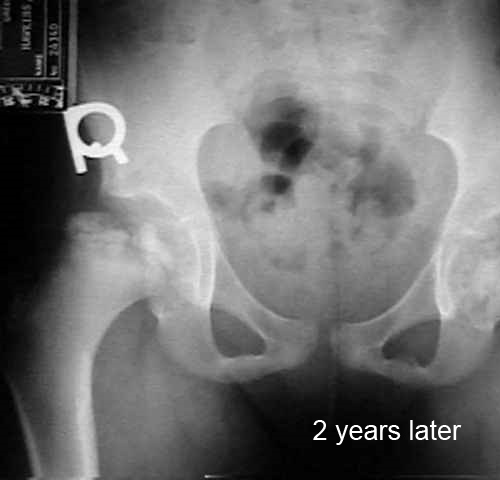 hip Legg-Calvé-Perthes age 8