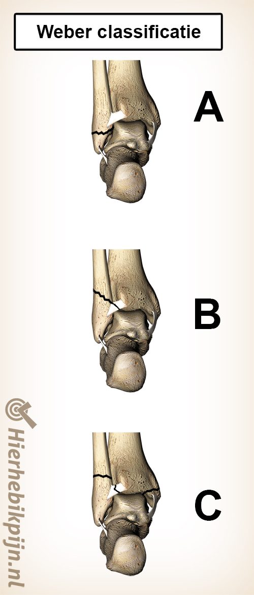 Weber classificatie kuitbeen breuk fractuur fibula